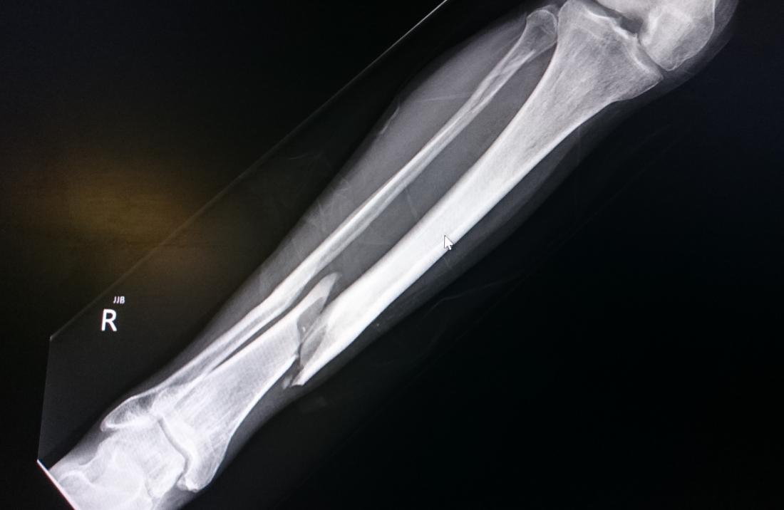 Tibia kırığı nasıl olur?